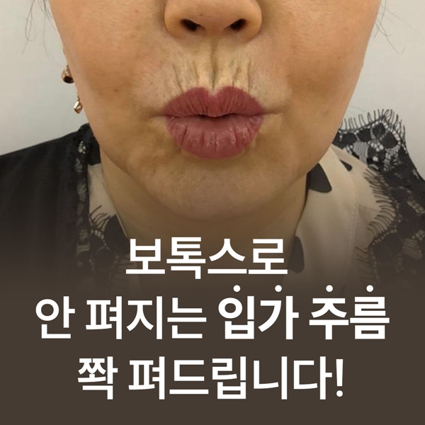 보톡스로 안펴지는 입가주름 쫙펴드릴게요