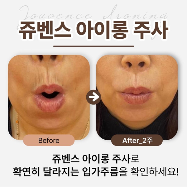 쥬벤스에서 아이롱주사로 확연히 달라지는 입가주름