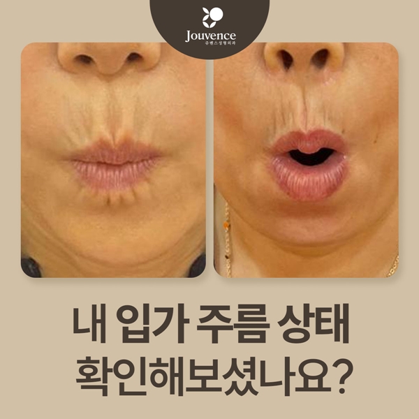 내 입가 주름 상태 확인해보셨나요?